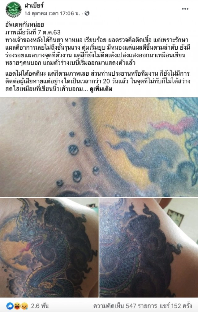 อัพเดท สาวสักพญานาค ช่างสักทำพิษ ติดเชื้ออย่างหนัก