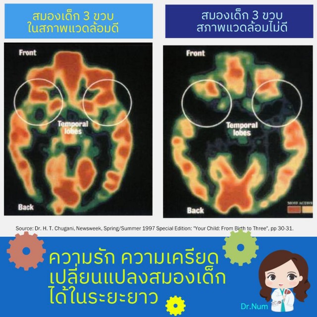 แพทย์ชี้สิ่งแวดล้อมมีผลกับสมองเด็กมากกว่าที่คิด