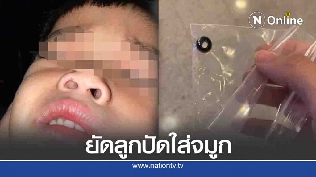 เตือนภัยแฟชั่นสายคล้องแมสก์ เด็ก 4 ขวบเอาลูกปัดยัดรูจมูก เตือนภัยแฟชั่นสายคล้องแมสก์ เด็ก 4 ขวบเอาลูกปัดยัดรูจมูก