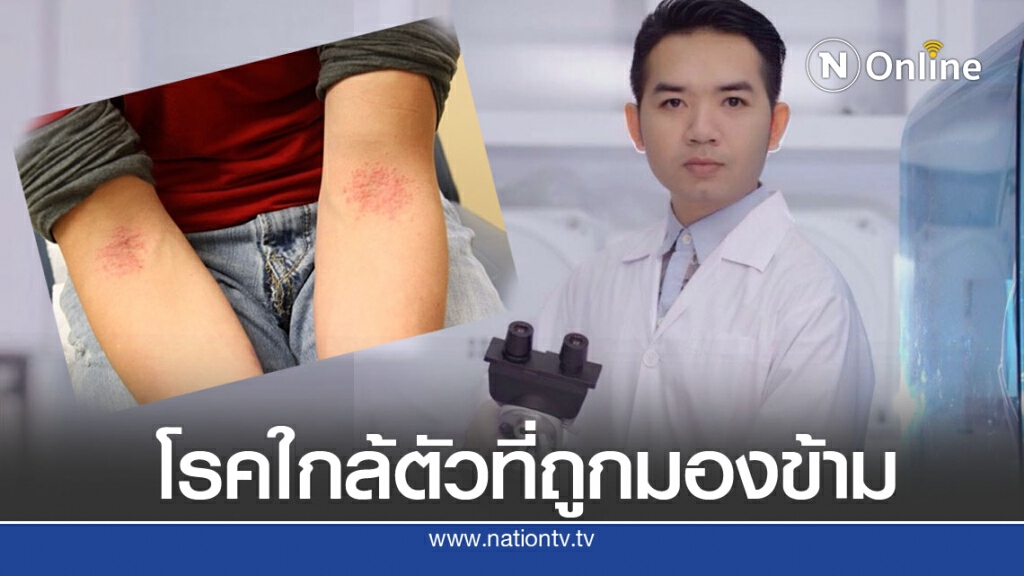 " หมอแล็บ " เผย ' โรคผื่นภูมิแพ้ผิวหนัง ' รุนแรงส่งผลต่อการใช้ชีวิต!! " หมอแล็บ " เผย ' โรคผื่นภูมิแพ้ผิวหนัง ' รุนแรงส่งผลต่อการใช้ชีวิต!!