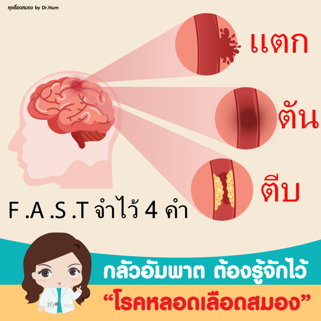 "โรคหลอดเลือดสมอง" ภัยเงียบที่หลีกเลี่ยงได้