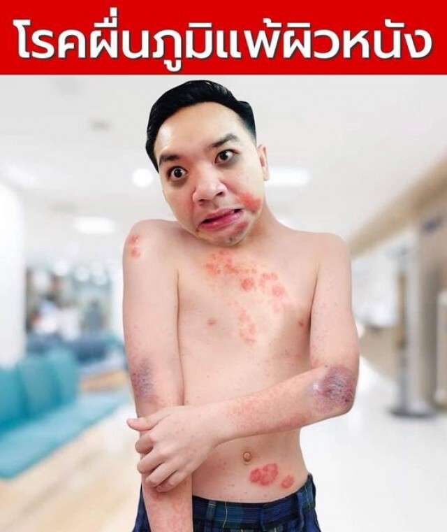 " หมอแล็บ " เผย ' โรคผื่นภูมิแพ้ผิวหนัง ' รุนแรงส่งผลต่อการใช้ชีวิต!!