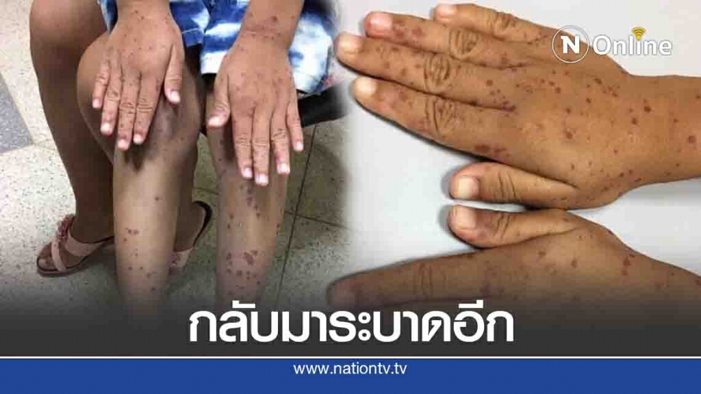 โรค มือ เท้า ปาก กลับมาระบาด เด็กป่วยเพียบ โรค มือ เท้า ปาก กลับมาระบาด เด็กป่วยเพียบ