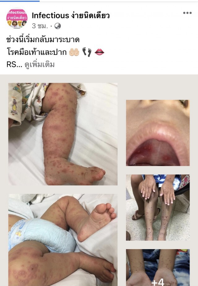 โรค มือ เท้า ปาก กลับมาระบาด เด็กป่วยเพียบ