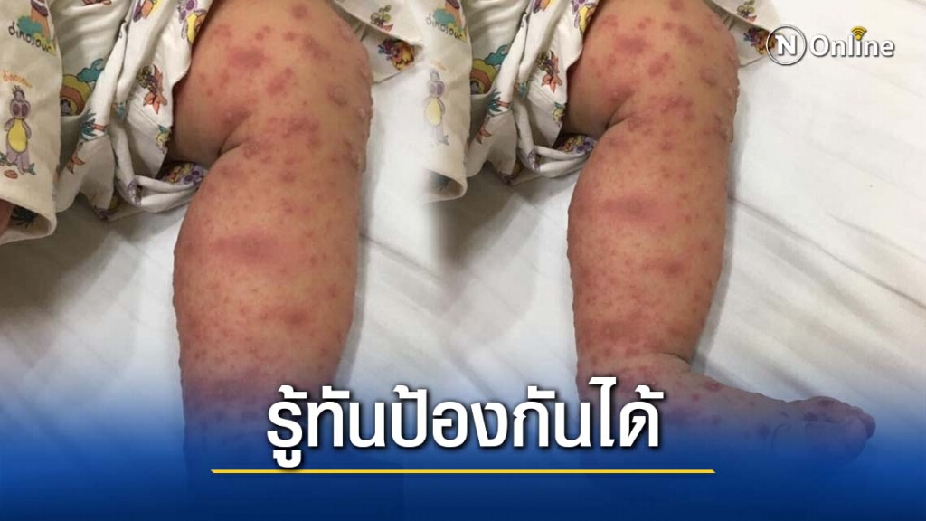 "โรค มือ เท้า ปาก " รู้ทัน ป้องกันได้
