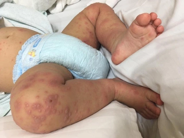 "โรค มือ เท้า ปาก " รู้ทัน ป้องกันได้