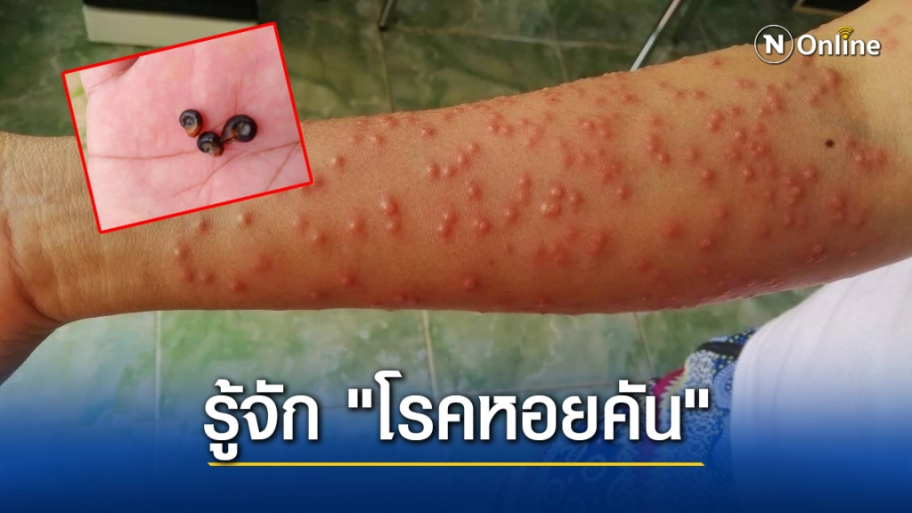 รู้จัก "โรคหอยคัน" ทำคนไข้มีตุ่มแดงคันนูนหลังดำนา