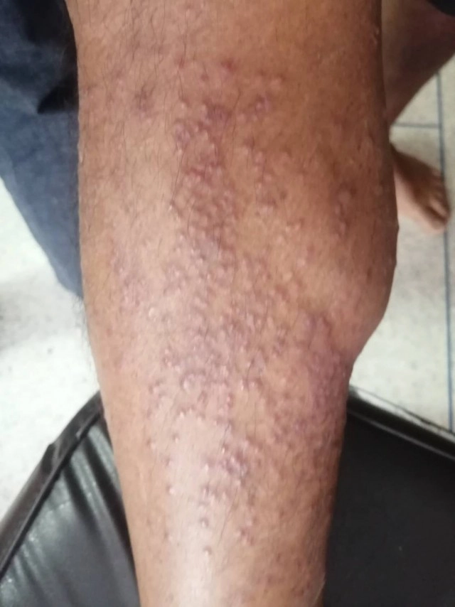 "หมอสุภัทร"ไขปริศนา "โรคหอยคัน" ระบาดในจังหวัดสงขลา