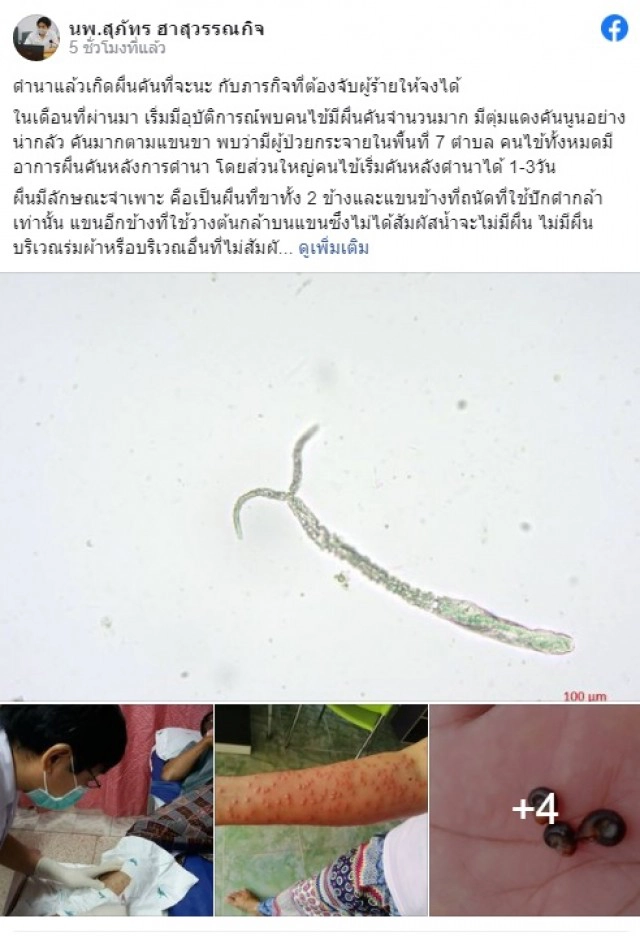 "หมอสุภัทร"ไขปริศนา "โรคหอยคัน" ระบาดในจังหวัดสงขลา