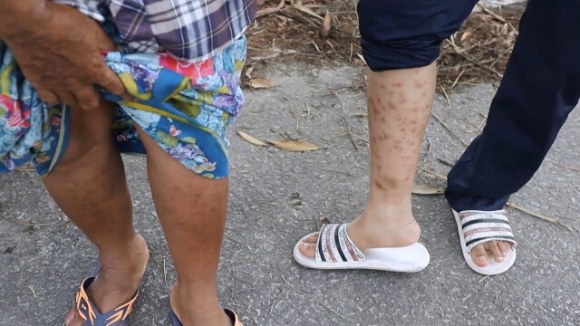 เร่งตรวจสอบ หลังชาวนาป่วยผื่นคัน กว่า 200 ราย