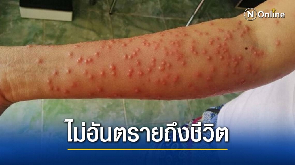 "แพทย์"แจง โรคพยาธิหอยคันแค่ผิวหนังอักเสบแต่ไม่อันตรายถึงชีวิต "แพทย์"แจง โรคพยาธิหอยคันแค่ผิวหนังอักเสบแต่ไม่อันตรายถึงชีวิต