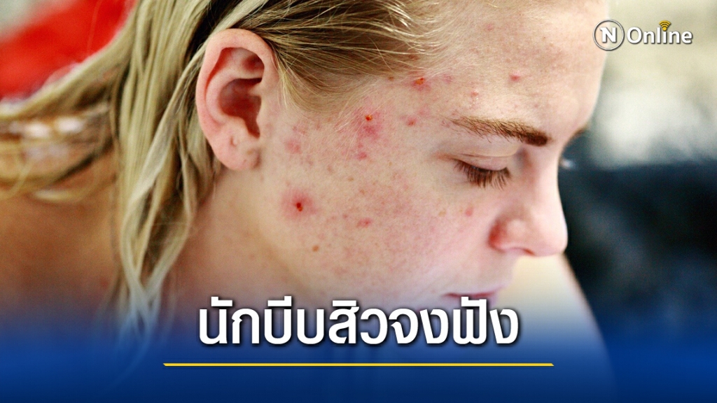 "หมอแล็บ" เผย บีบสิวปลายจมูกเสี่ยงติดเชื้อในสมอง "หมอแล็บ" เผย บีบสิวปลายจมูกเสี่ยงติดเชื้อในสมอง