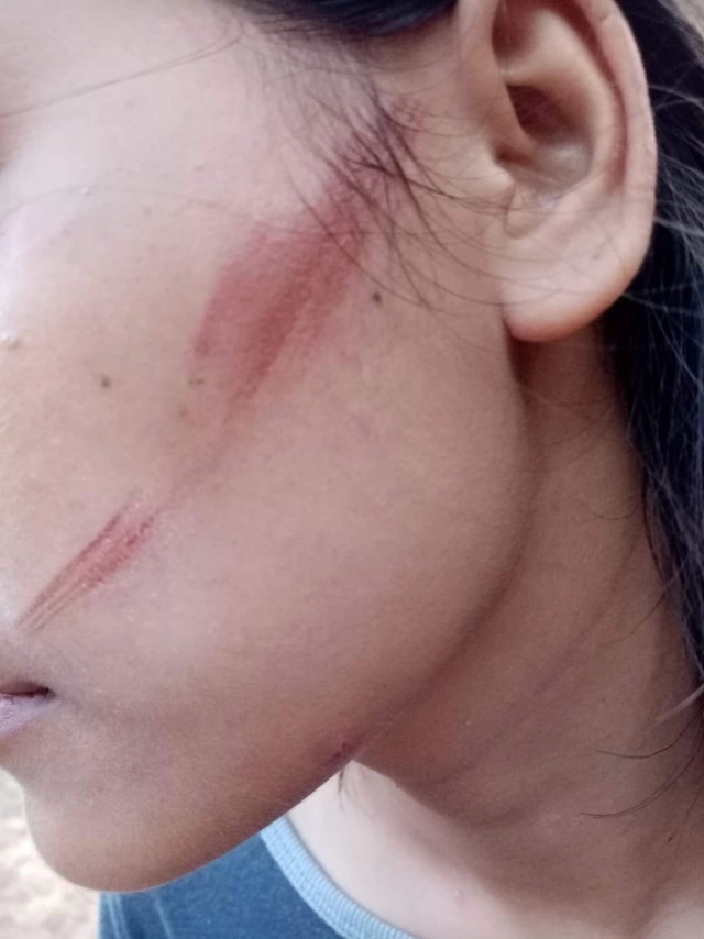 หวิดคอขาดอีกแล้ว สายสื่อสารปาดคอขณะขับรถ