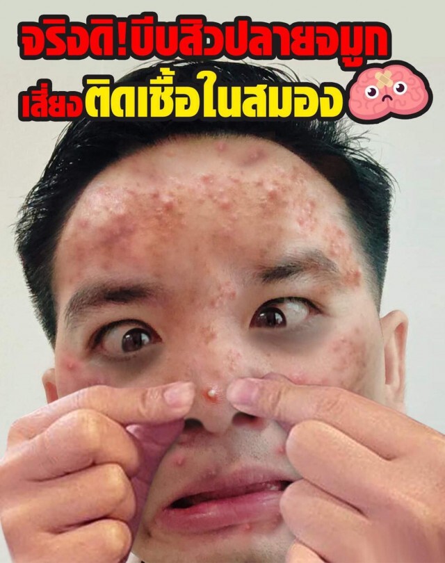 "หมอแล็บ" เผย บีบสิวปลายจมูกเสี่ยงติดเชื้อในสมอง