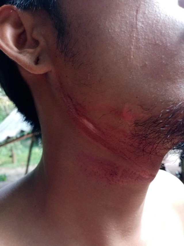 หวิดคอขาดอีกแล้ว สายสื่อสารปาดคอขณะขับรถ