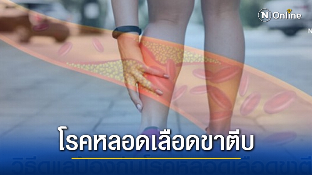 เพจดังแนะ 10 วิธีดูแลและป้องกันโรคหลอดเลือดขาตีบ