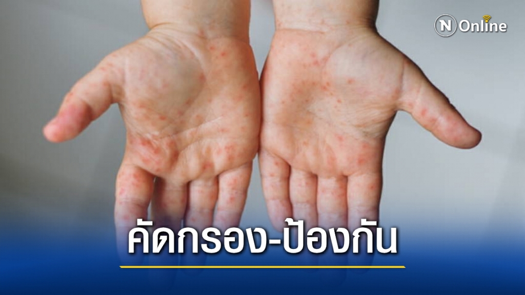 แพทย์แนะครู ผู้ปกครอง คัดกรองสุขภาพเด็กทุกวันก่อนเข้าเรียน สกัดโรคมือเท้าปาก แพทย์แนะครู ผู้ปกครอง คัดกรองสุขภาพเด็กทุกวันก่อนเข้าเรียน สกัดโรคมือเท้าปาก