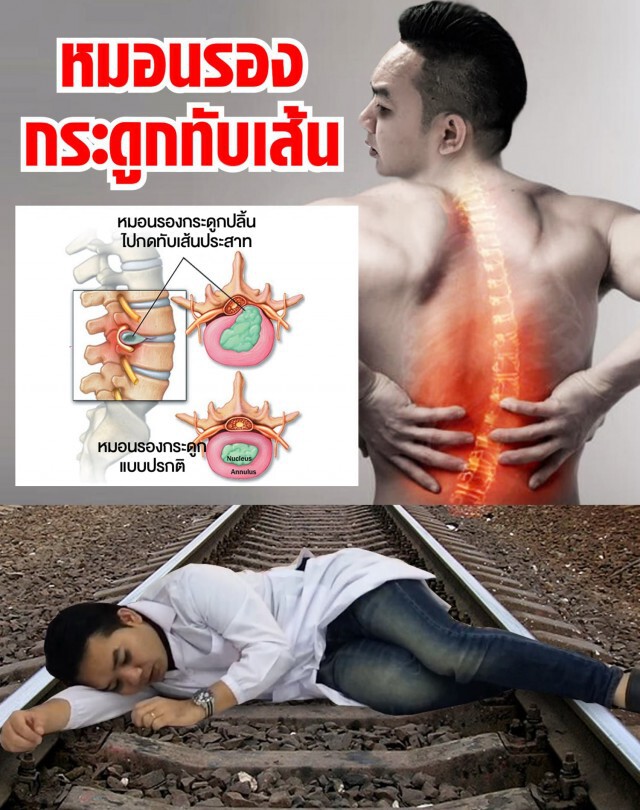 "หมอแล็บ"เตือน 'หมอนรองกระดูกทับเส้น' ไม่ควรนิ่งนอนใจ