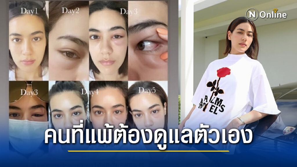"คิมเบอร์ลี่" เตือนอุทาหรณ์ โพสต์ภาพตาบวม หลังแพ้ฝุ่น PM2.5 หนักมาก