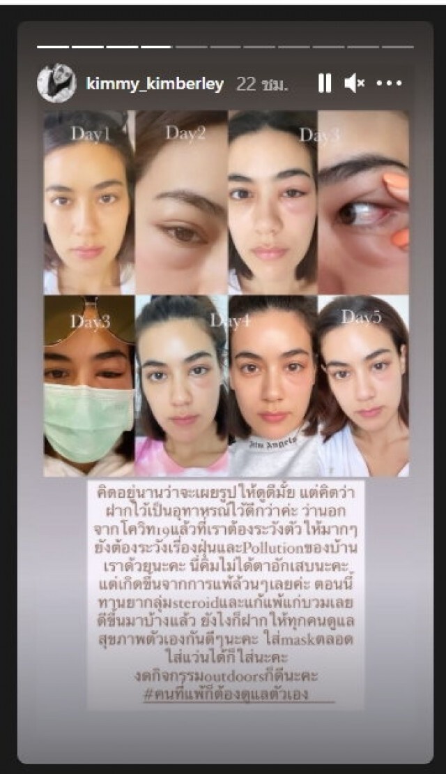 "คิมเบอร์ลี่" เตือนอุทาหรณ์ โพสต์ภาพตาบวม หลังแพ้ฝุ่น PM2.5 หนักมาก