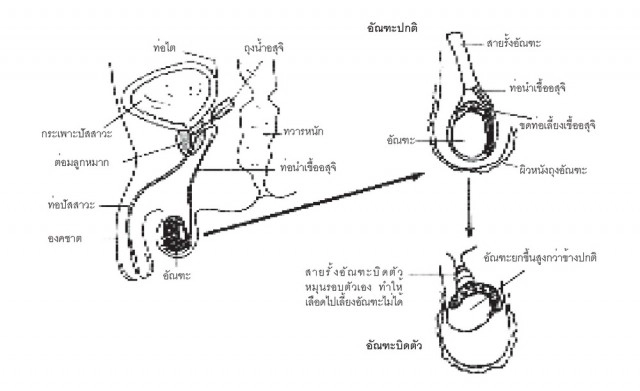 "อัณฑะบิดตัว" ภัยร้าย! ที่ผู้ชายควรรู้ รักษาไม่ทันเสี่ยงถูกตัด!