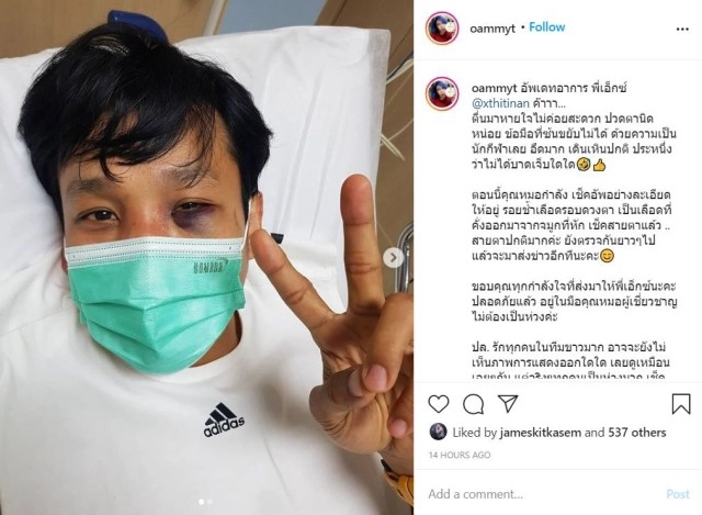 "เอ็กซ์ ธิตินันท์" เจ็บหนัก! ดวงตาฟกเขียวคล้ำ จนแฟนคลับเป็นห่วง หลังเจอพลังหมัด "รัศมีแข"