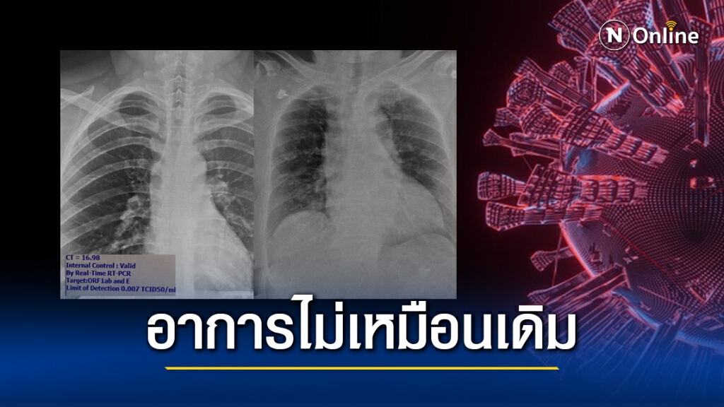 แพทย์ ชี้ อาการผู้ป่วยโควิด-19รอบนี้ไม่เหมือนเดิม แพทย์ ชี้ อาการผู้ป่วยโควิด-19รอบนี้ไม่เหมือนเดิม
