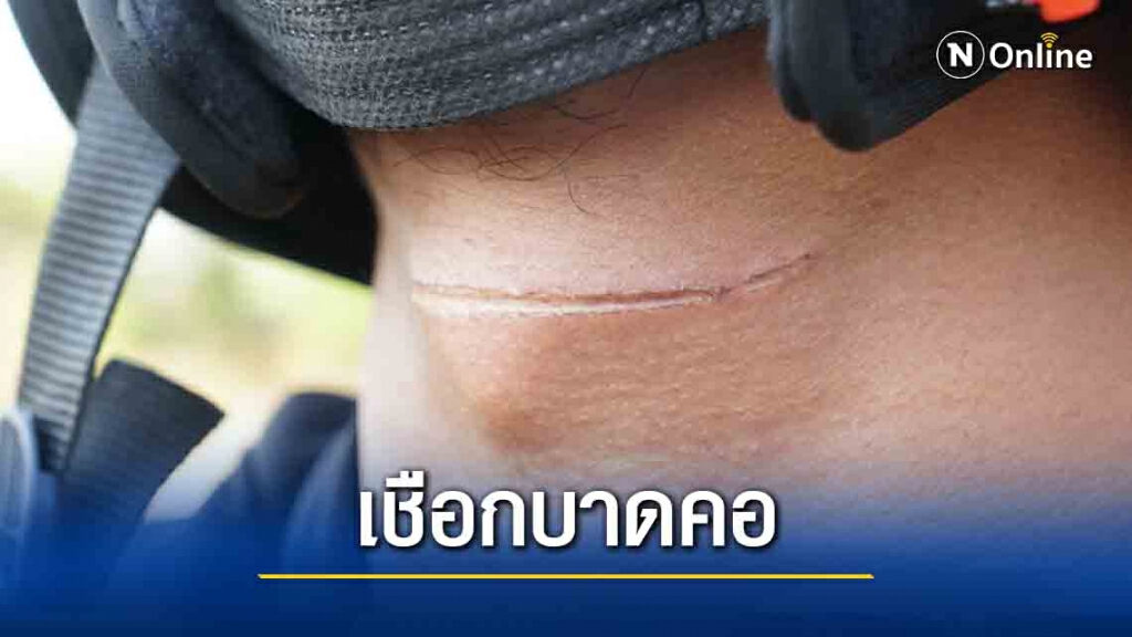 บุรีรัมย์-หนุ่มขับ จยย.เจอเชือกปริศนาบาดคอหวิดโดนหลอดลม บุรีรัมย์-หนุ่มขับ จยย.เจอเชือกปริศนาบาดคอหวิดโดนหลอดลม