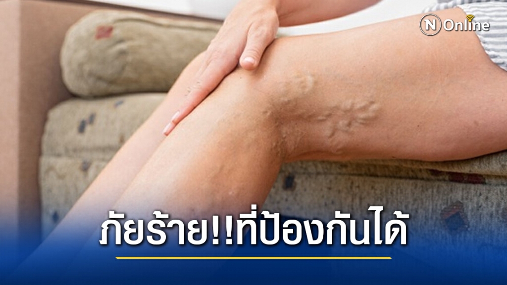 หลอดเลือดขอด ภัยร้าย!!ที่ป้องกันได้ หลอดเลือดขอด ภัยร้าย!!ที่ป้องกันได้