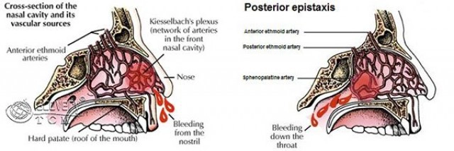 5 ทริคหยุดเลือดกำเดาไหล