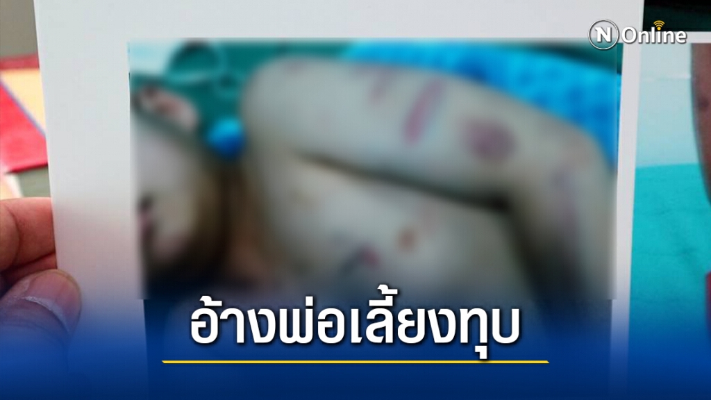 ร้องมูลนิธิปวีณา อ้างพ่อเลี้ยงทุบลูกติดเมียน่วมทั้งตัว