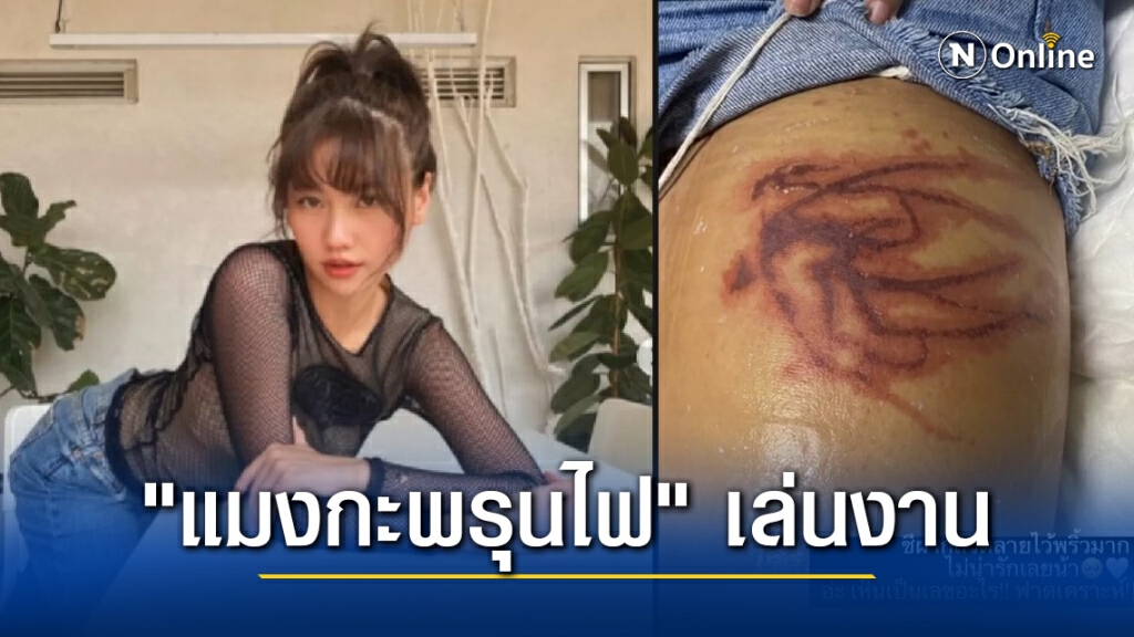 "เมทัล" โชว์บาดแผลโดน "แมงกะพรุนไฟ" เล่นงานหนัก ทั้งมือและขา