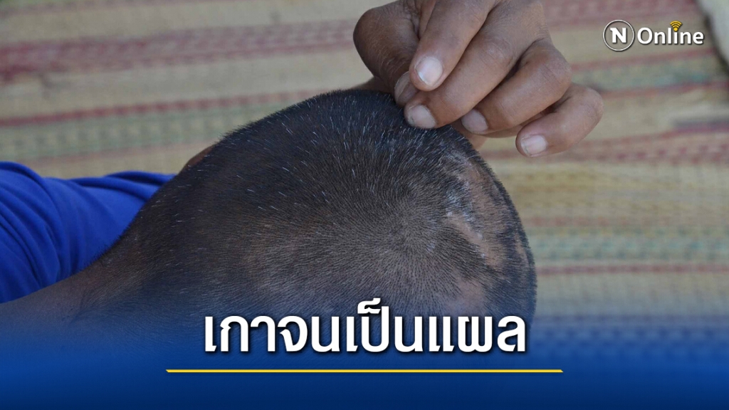 ชายพิการป่วยโรคประหลาดแมลงชอนไชโผล่ผิวหนัง