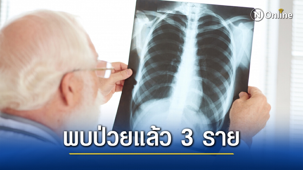 กรมควบคุมโรคเตือนปชช.ระวังป่วย "วัณโรคดื้อยาหลายขนานชนิดรุนแรงมาก"