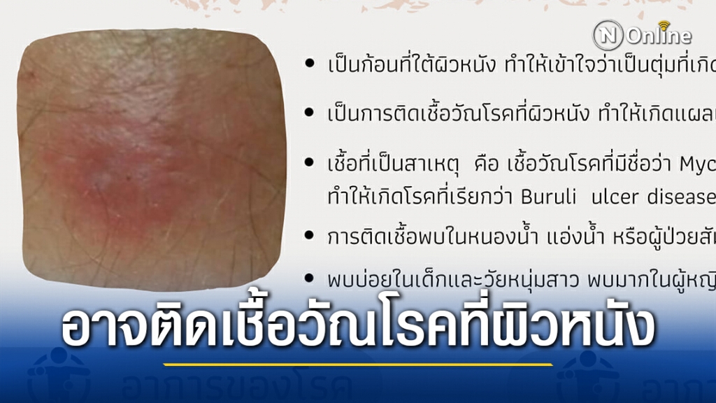 แพทย์ผิวหนังเตือน แผลที่คล้ายแมลงกัด อาจเป็นการติดเชื้อวัณโรคที่ผิวหนังได้