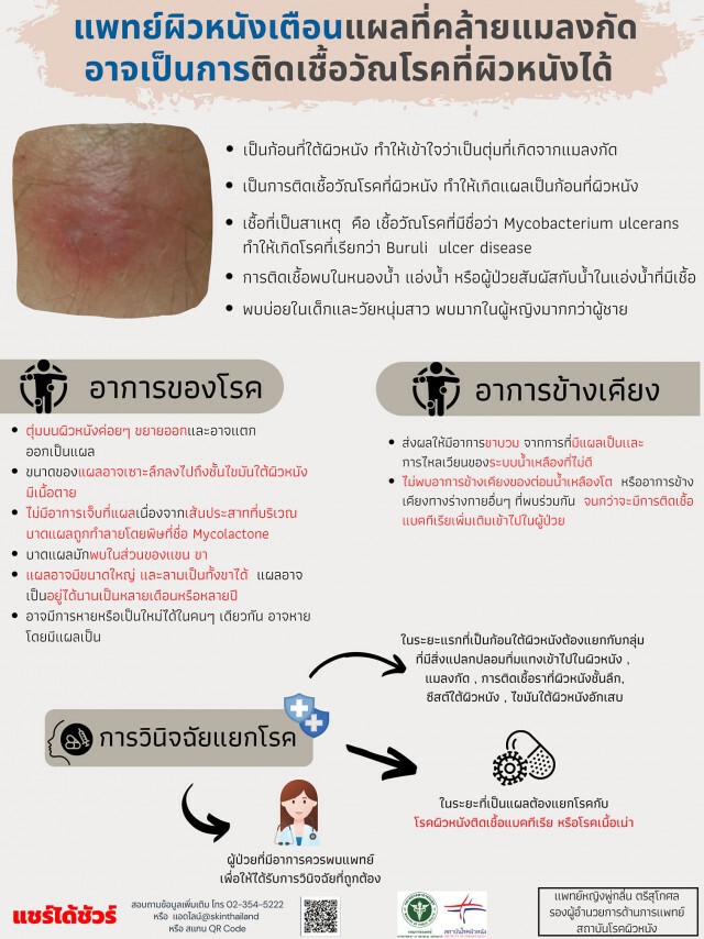 แพทย์ผิวหนังเตือน แผลที่คล้ายแมลงกัด อาจเป็นการติดเชื้อวัณโรคที่ผิวหนังได้