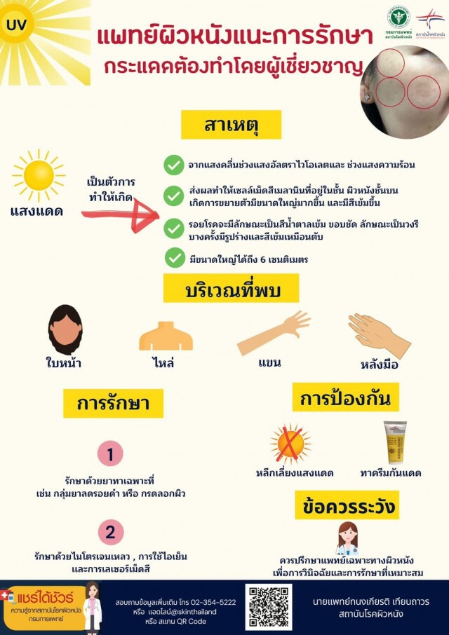 แพทย์ผิวหนัง แนะการรักษากระแดด ต้องทำโดยผู้เชี่ยวชาญ