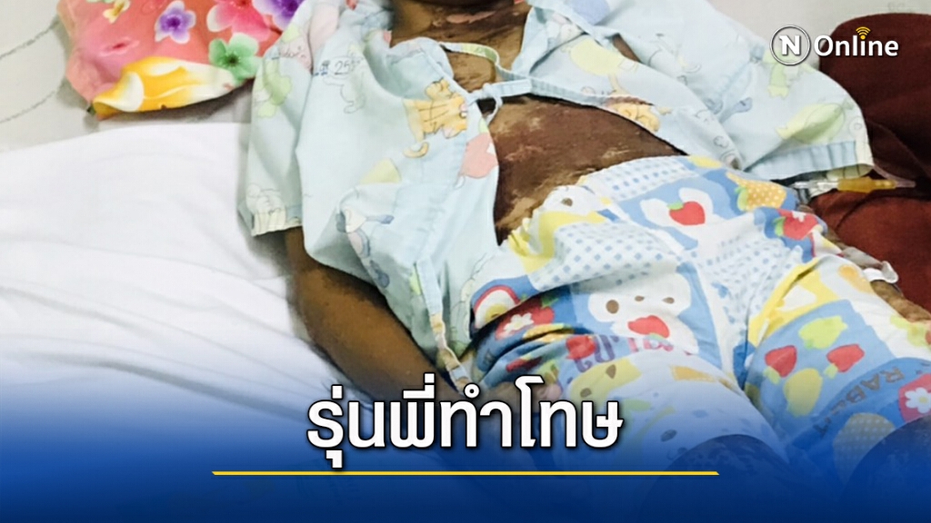 รุ่นพี่ทำโทษน้อง ป.2 ใช้ "ซีม่า" ราดตัวเจ็บสาหัส