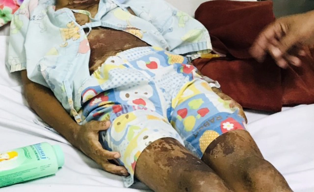 รุ่นพี่ทำโทษน้อง ป.2 ใช้ "ซีม่า" ราดตัวเจ็บสาหัส