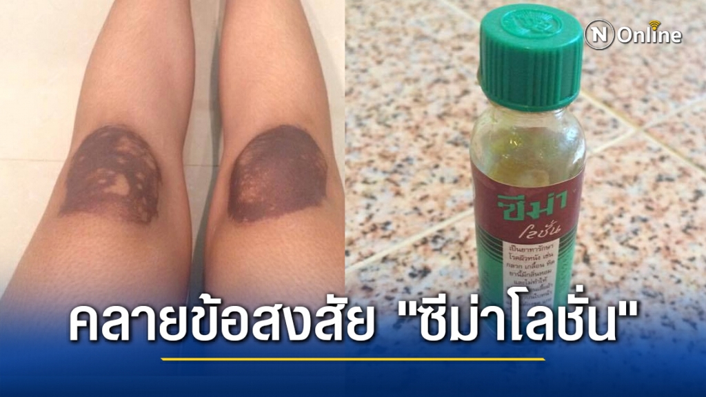 เพจหมอ คลายข้อสงสัย "ซีม่าโลชั่น" พบสารเคมีหลายชนิดกัดทำลายผิวหนังได้