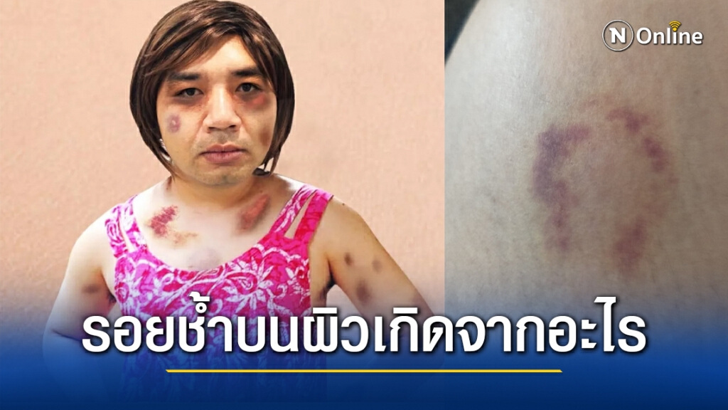 "หมอแล็บแพนด้า" ไขข้อข้องใจ รอยช้ำบนผิวหนังเกิดจากอะไร? "หมอแล็บแพนด้า" ไขข้อข้องใจ รอยช้ำบนผิวหนังเกิดจากอะไร?
