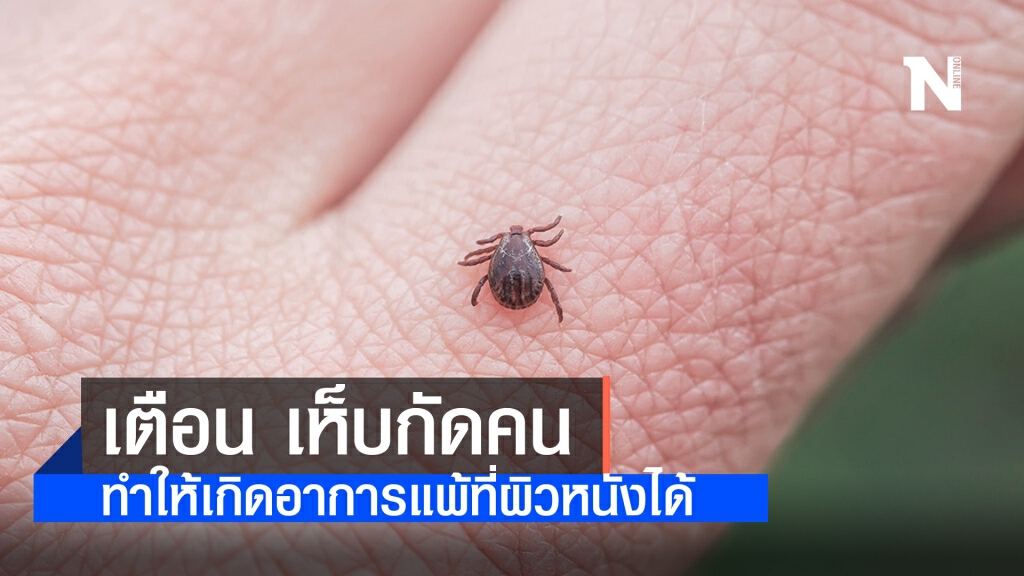 แพทย์ผิวหนังเตือน เห็บกัดคนทำให้เกิดอาการแพ้ที่ผิวหนังได้