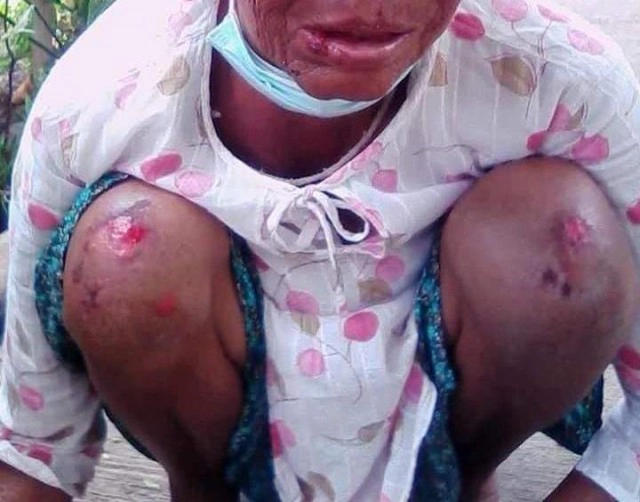 ลูกป่วยจิตขาดยาคลั่งใช้ไม้ไล่ตีแม่บาดเจ็บ