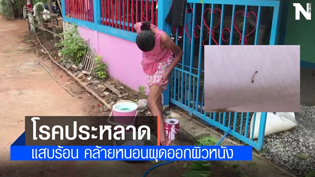 ป้าวอนช่วยเหลือปวดแสบร้อนคล้ายหนอนออกรูขุมขน ป้าวอนช่วยเหลือปวดแสบร้อนคล้ายหนอนออกรูขุมขน