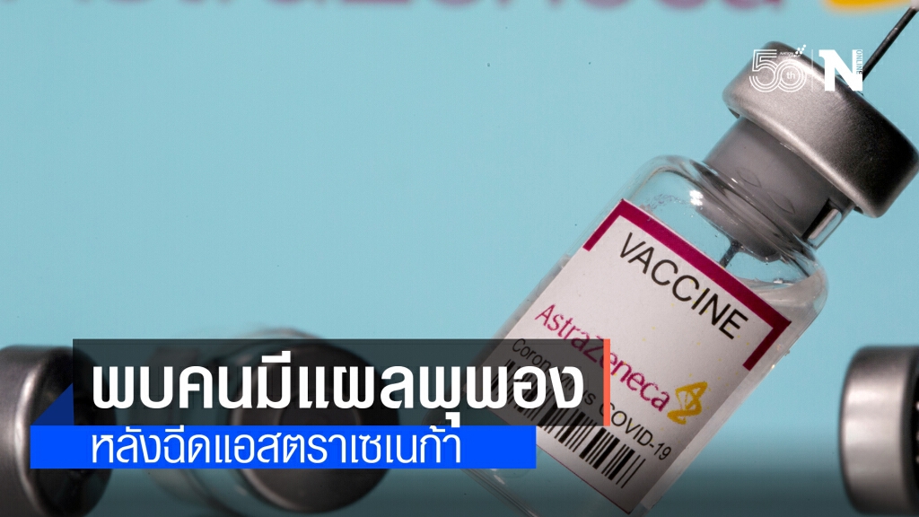 เจออีก!! ผลกระทบจาก "แอสตราเซเนก้า" ทำให้เกิดแผลพุพอง