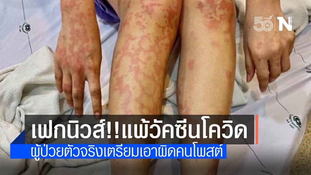 เฟกนิวส์! สาวฉีดวัคซีนโควิดป่วยหนัก ที่แท้มโนแต่งเรื่อง