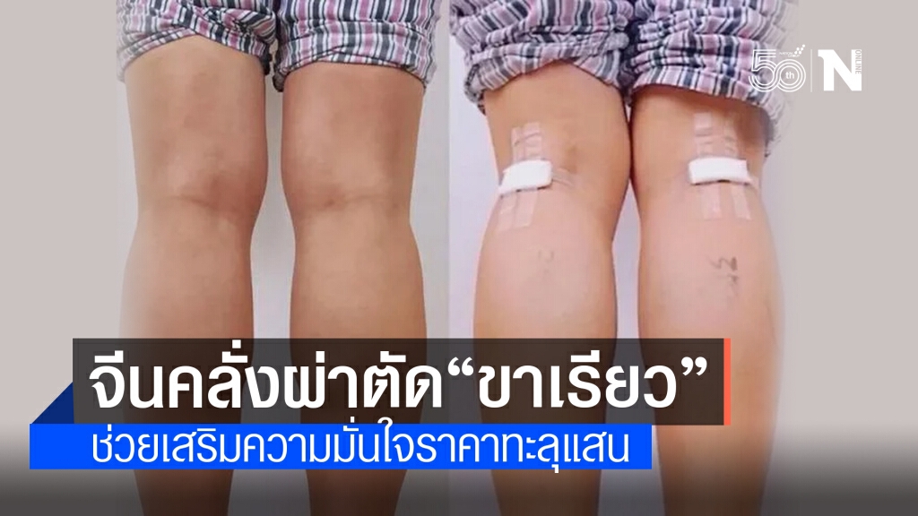 ฮือฮา! สาวจีนคลั่งผ่าตัด "ขาเรียว" ราคาแพงทะลุแสน