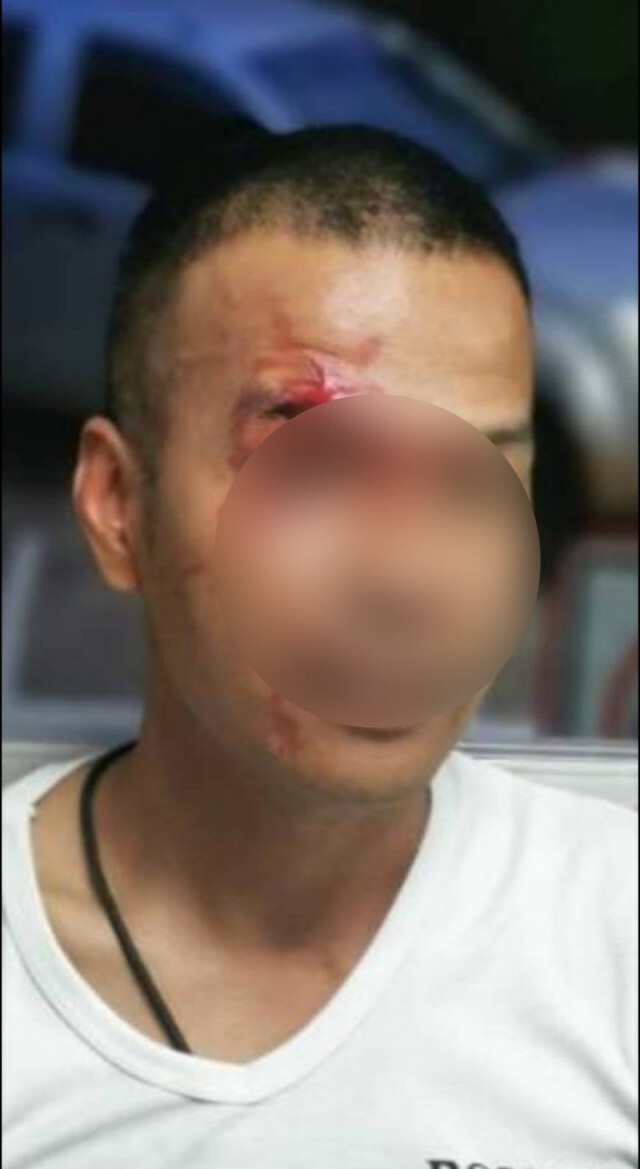 ผู้ต้องหาสะเดาะกุญแจชกหน้าตำรวจเย็บ 3 เข็ม