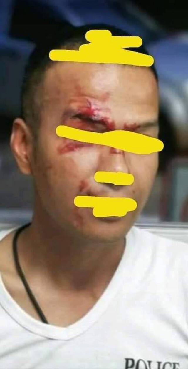 ผู้ต้องหาสะเดาะกุญแจชกหน้าตำรวจเย็บ 3 เข็ม
