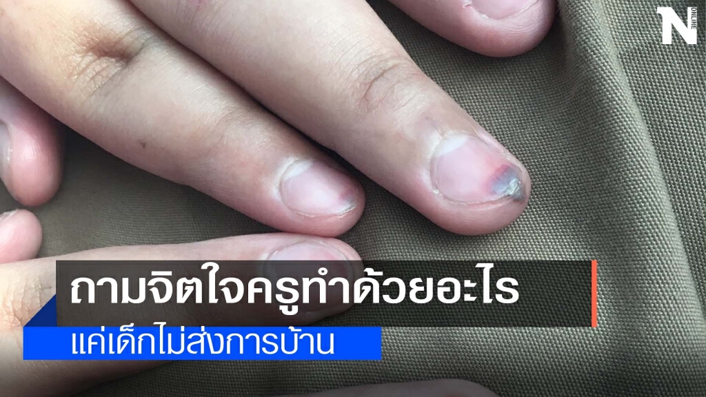 แม่รับไม่ได้ครูทำโทษลูกป.6 ใช้แปรงตีนิ้วห้อเลือด